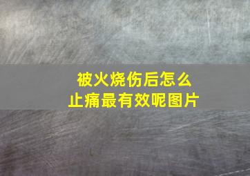 被火烧伤后怎么止痛最有效呢图片